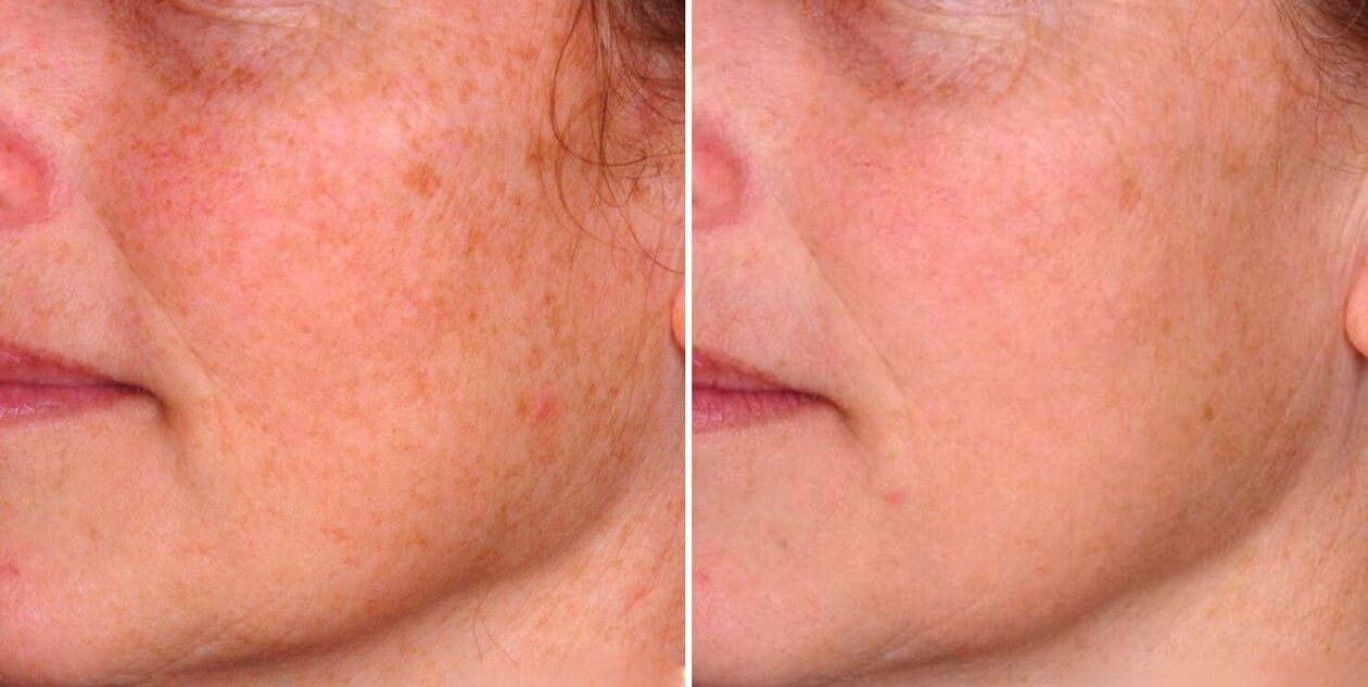 The result of fractional photothermolysis is the reduction of age spots on the skin of the face. 