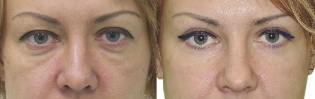 Photos before and after the outline of the eyelid