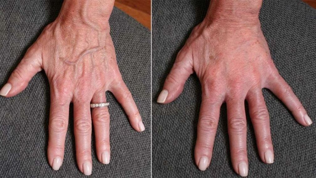 contour plastic, photo 1 of hand rejuvenation before and after